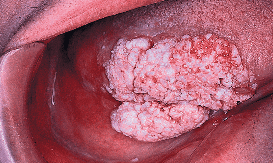 Verrucous Carcinoma of mouth